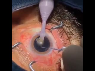 Операция по удалению катаракты с помощью всасывания!
