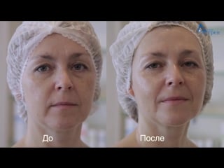 Феруловый пилинг ferulic a12 w s мастер класс всесезонные пилинги dermatime (испания)