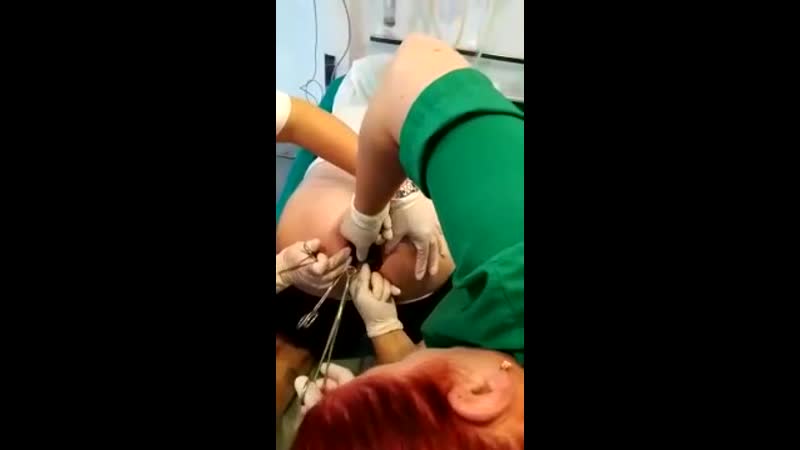 Хирурги достают пробку из жопы мужика