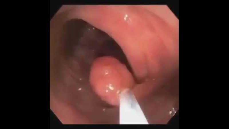 Удаление полипа толстой кишки!