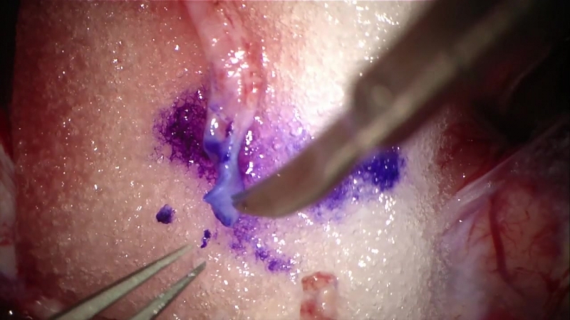 Гигантская аневризма сма клипинг с реваскуляризацией