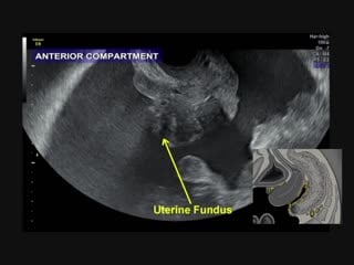 Ultrasound in preoperative assessment of pelvic and abdominal spread in patients