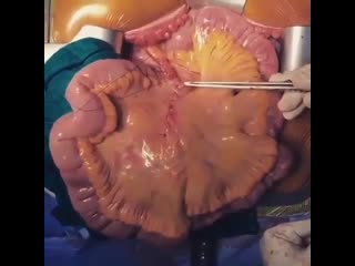 Закрытие дефекта после резекции кишечника