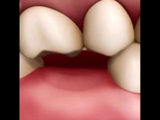 Что будет, если вовремя не поставить имплант ⚠