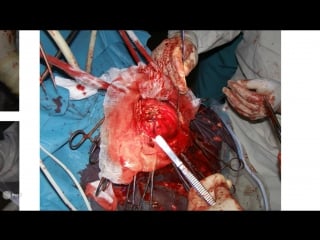 3 клинический случай оружейное ранение головного мозга