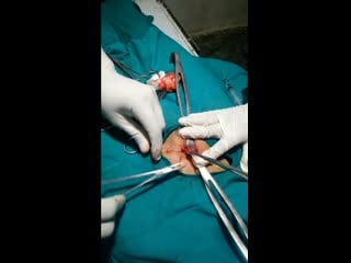 Mini laparotomy for tubal ligation in mobile family planning camp at remote area [720p]