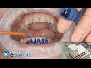 Professional oral hygiene dte pt 5 acteon kerr hawe dentsply (fhd multistream)