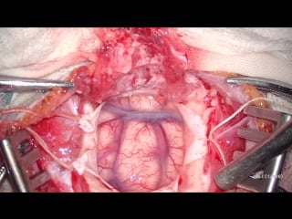 15 церебромиопексия при болезни мойя мойя