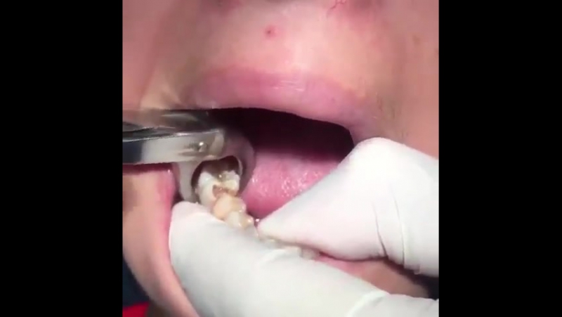 Удаление зуба