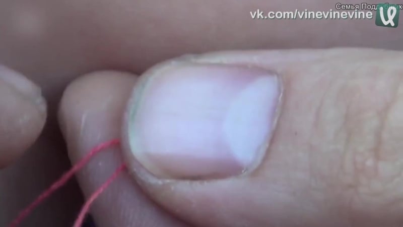 Как вытащить клеща ниткой