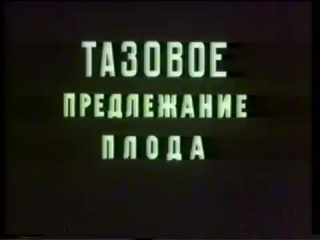 Тазовое предлежание плода