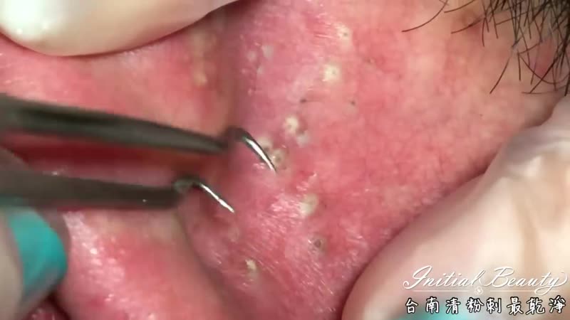 Выдавливание черных точек за ухом