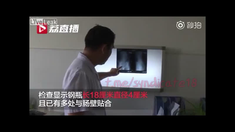 18 летний мальчик неделю держал газовый баллон в заднем проходе