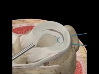 Продольный, или разрыв ручки ковша, возникает, когда мениск разорван по его окружности и его внутреннее поле смещено ⁣