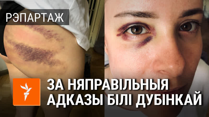 «6 амапаўцаў білі мяне нагамі і дубінкамі» дзяўчыну катавалі, каб прызналася,што каардынуе пратэсты
