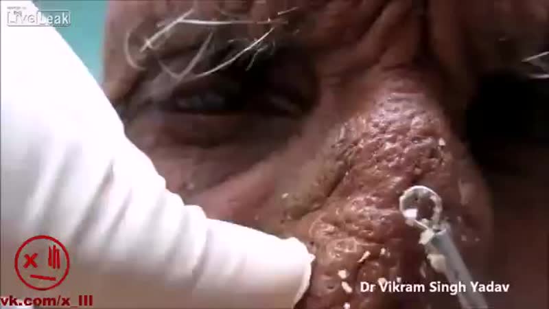 Для тех, кто на диете (как правильно давить прыщи) (360p) mp4