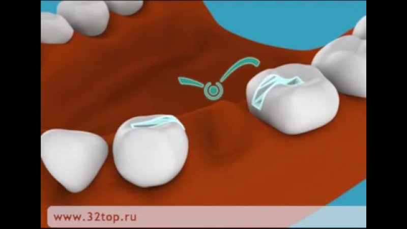 Адгезивное протезирование