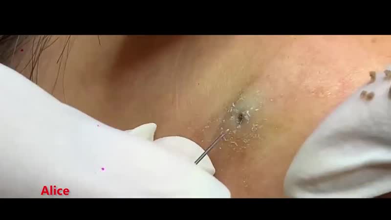 Кисты porn video – Выдавливание кисты