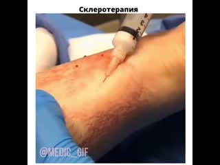 Склеротерапия