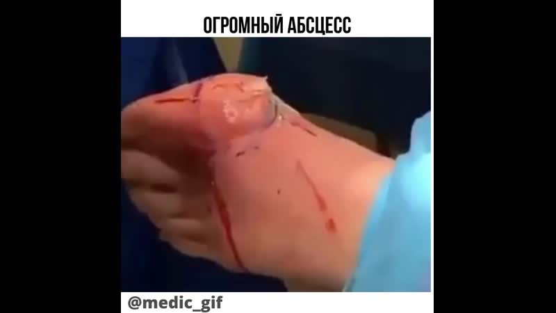 Огромный абсцесс