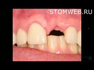 Biologic strategies to enhance clinical and aesthetic success in oral implantology