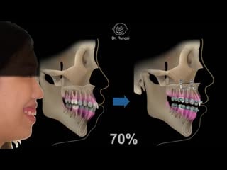 Gummy smile chris aao 2019 【live!!!!!!!】 hot!!! ортодонтия