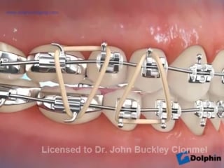 Elastics (delta first molar open bite) wmv orthodontic elastics ортодонтия