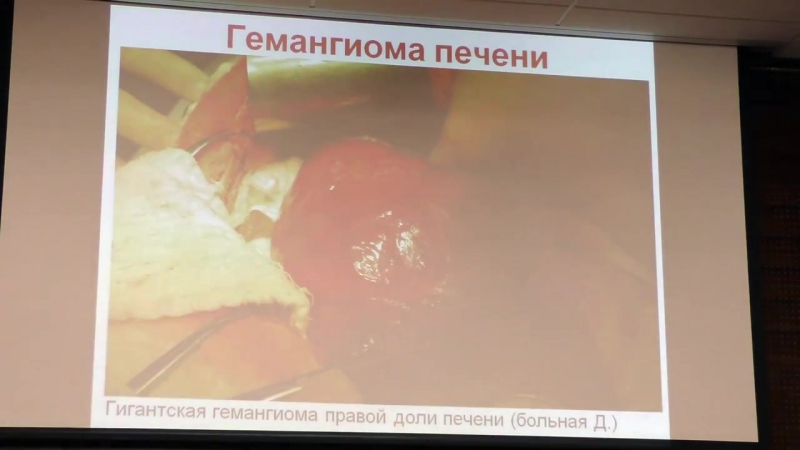Пышкин с а объемные образования печени гепатоцеллюлярная карцинома