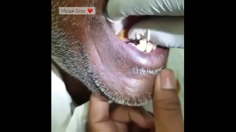 Образование камней в слюнных железах