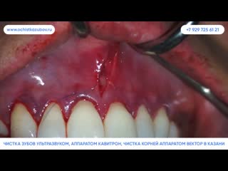 Ochistkazubov ru – чистка зубов вектором в казани