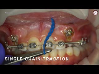 Exposure and traction of labial impacted canines, traction by power chain, amr asker ортодонтия