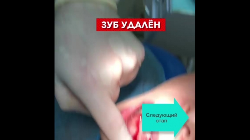 Одномоментная имплантация 36 зуба