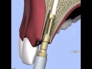 Процесс устанои зубного импланта