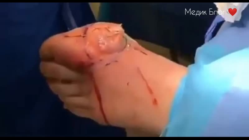 Этот абсцесс возник из за инфекции после травматического повреждения