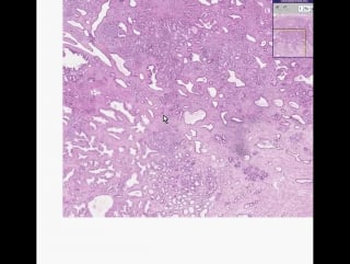 Prostate adenocarcinoma (gleason grade 2)