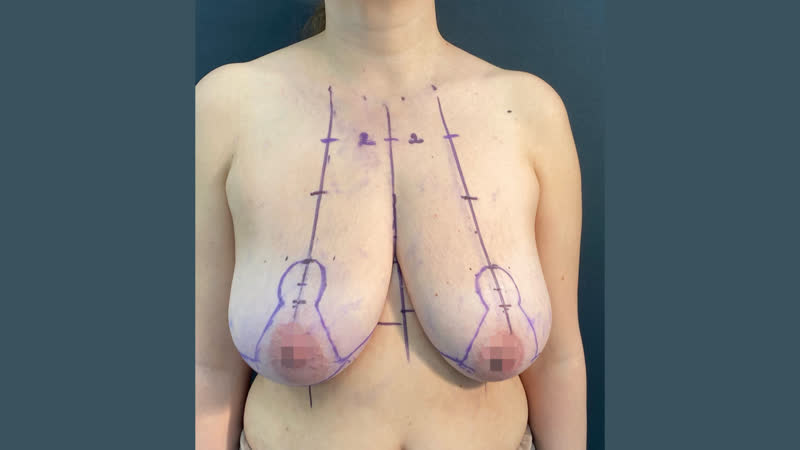 Подтяжка молочных желез без имплантатов (мастопексия)