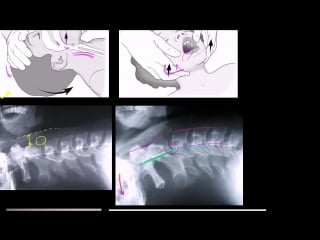 Защита шейного отдела позвоночника при освобождении дыхательных путей (не заменяет формальное обучен