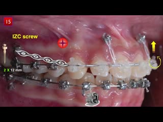 Gummy smile aao 2019 part 2 ортодонтия