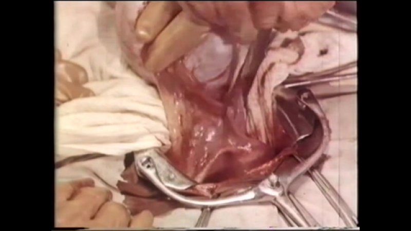 Овариоэктомия, удаление яичников при раке молочной железы © oophorectomy, removal of the ovaries