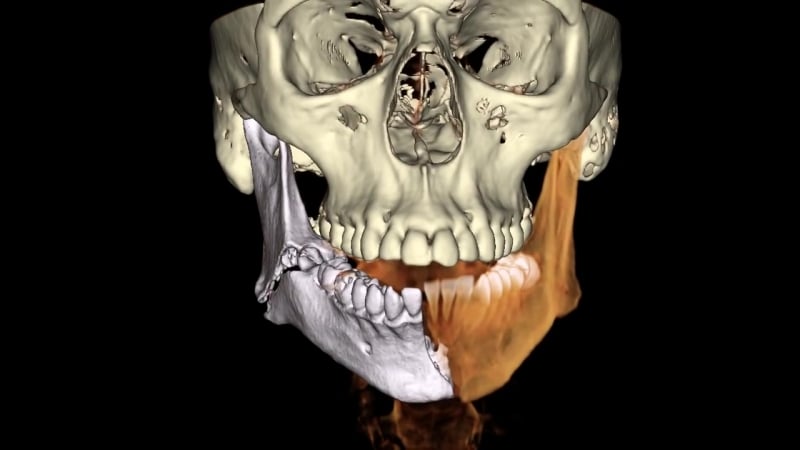 Виртуальная реконструкция перелома нижней челюсти хирургическая стоматология