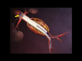 Deployment of an endovascular graft in an abdominal aortic aneurysm