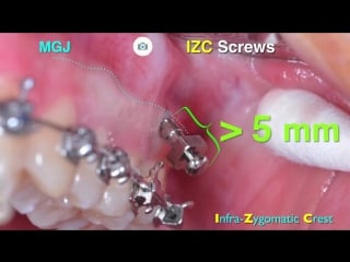 2018 aao innovative impaction treatment part 1（live）ортодонтия