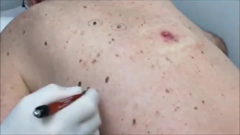 Удаление огромных черных точек на спине