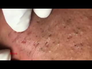 Чистка лица черные точки, воспаленные прыщи