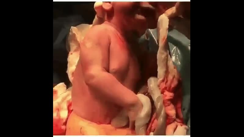 Кесарево сечение