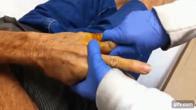 Вправление вывиха пальца