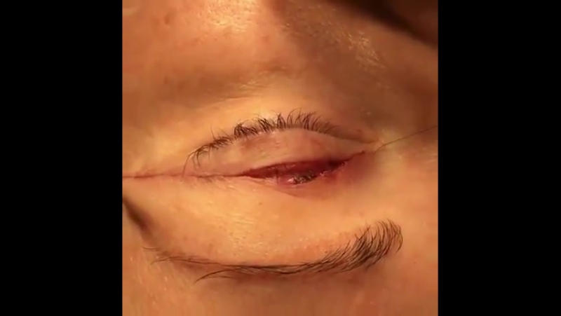 Блефаропластика 👀🔪