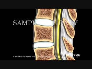 Epidural steroid injections