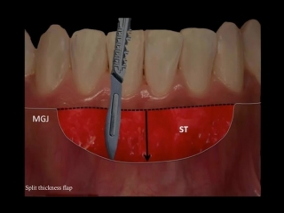 How does a free gingival graft work (surgicalmaster video)