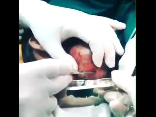 Нижнечалюстной абсцесс